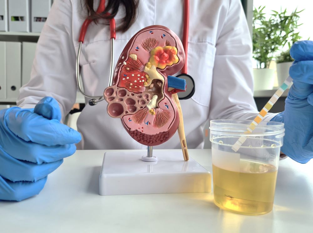 The Importance of Urine Protein Test Strips for Nephrotic Syndrome